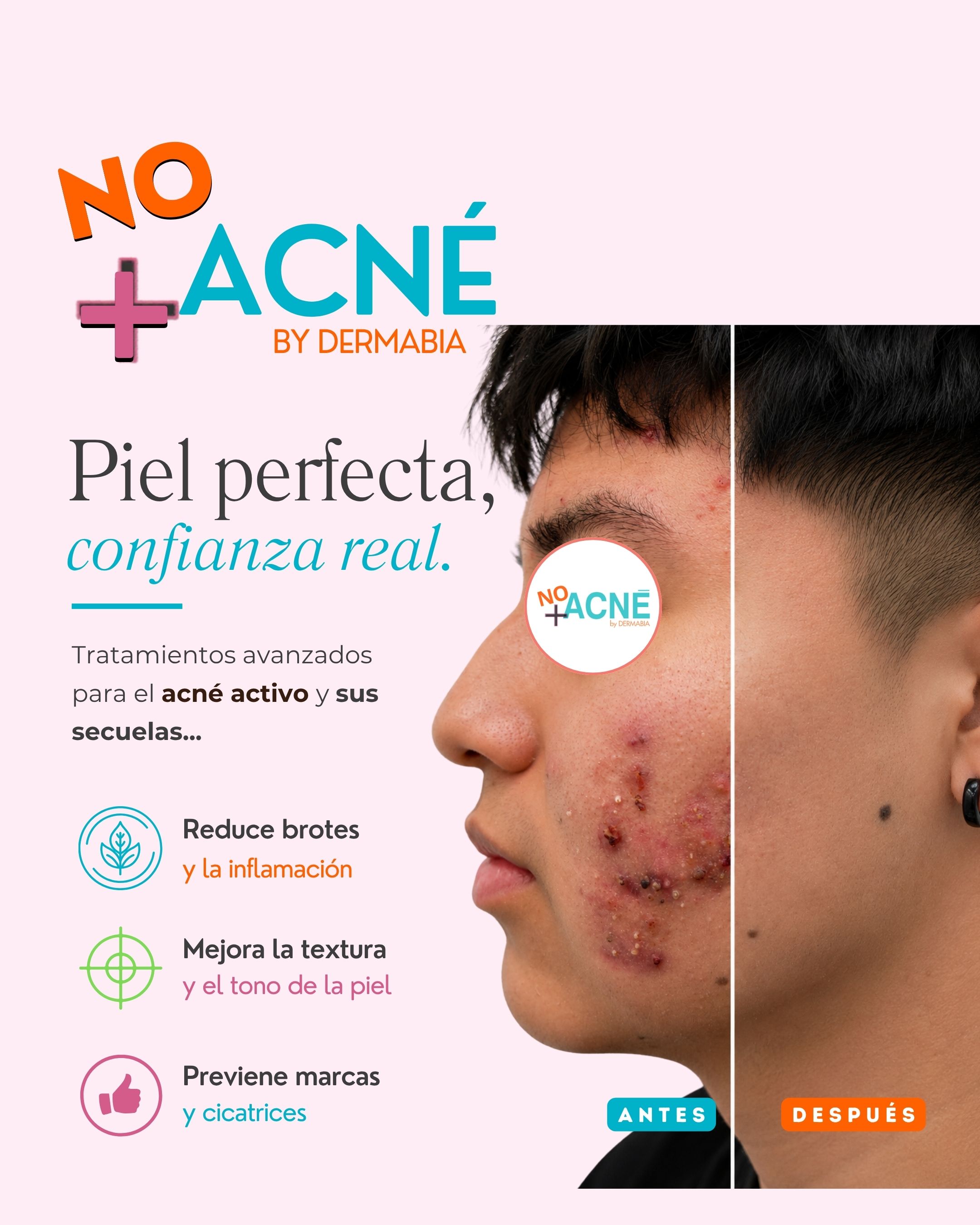 Antes y después del tratamiento de marcas de acné — resultado real 1