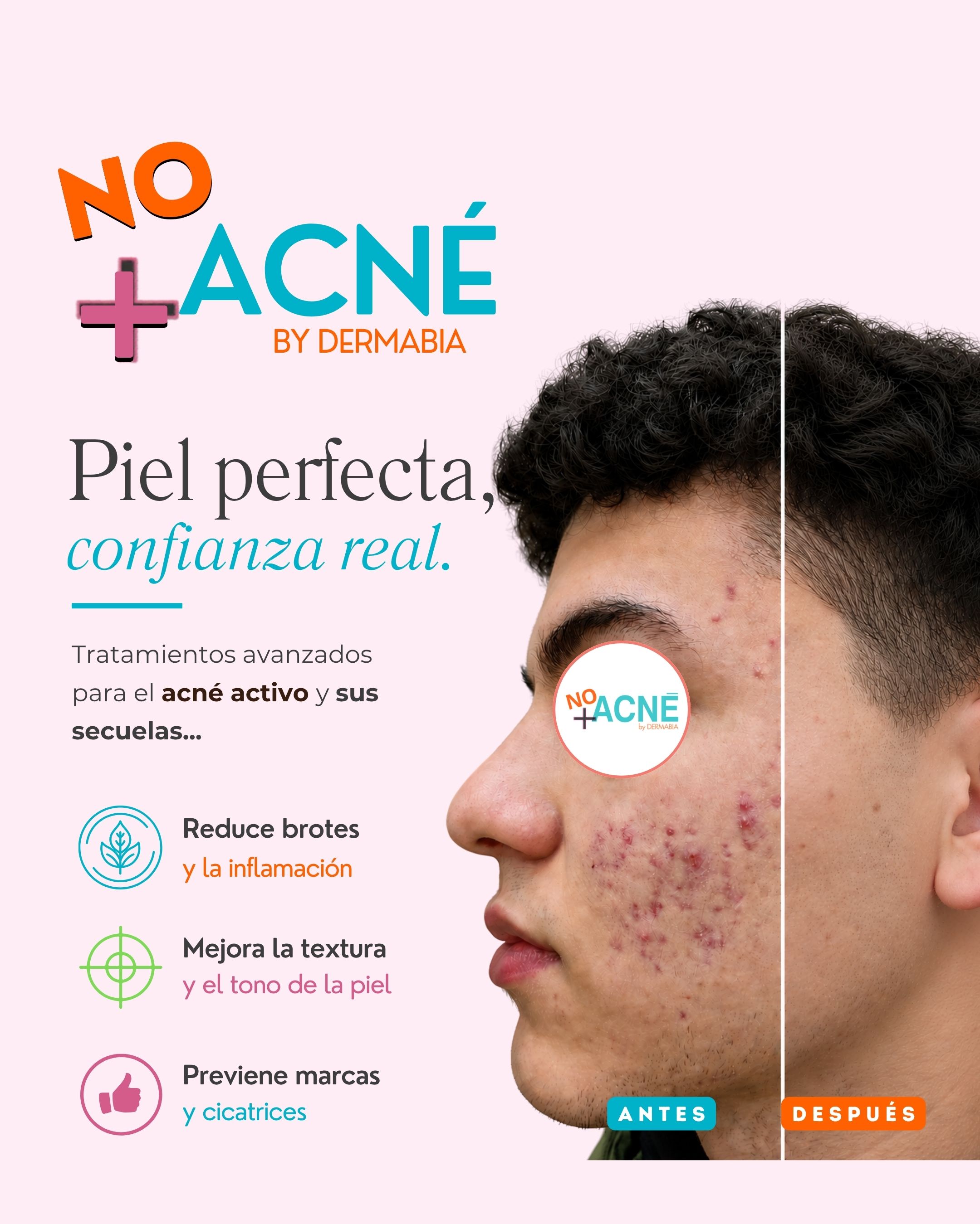Antes y después del tratamiento de marcas de acné — resultado real 2