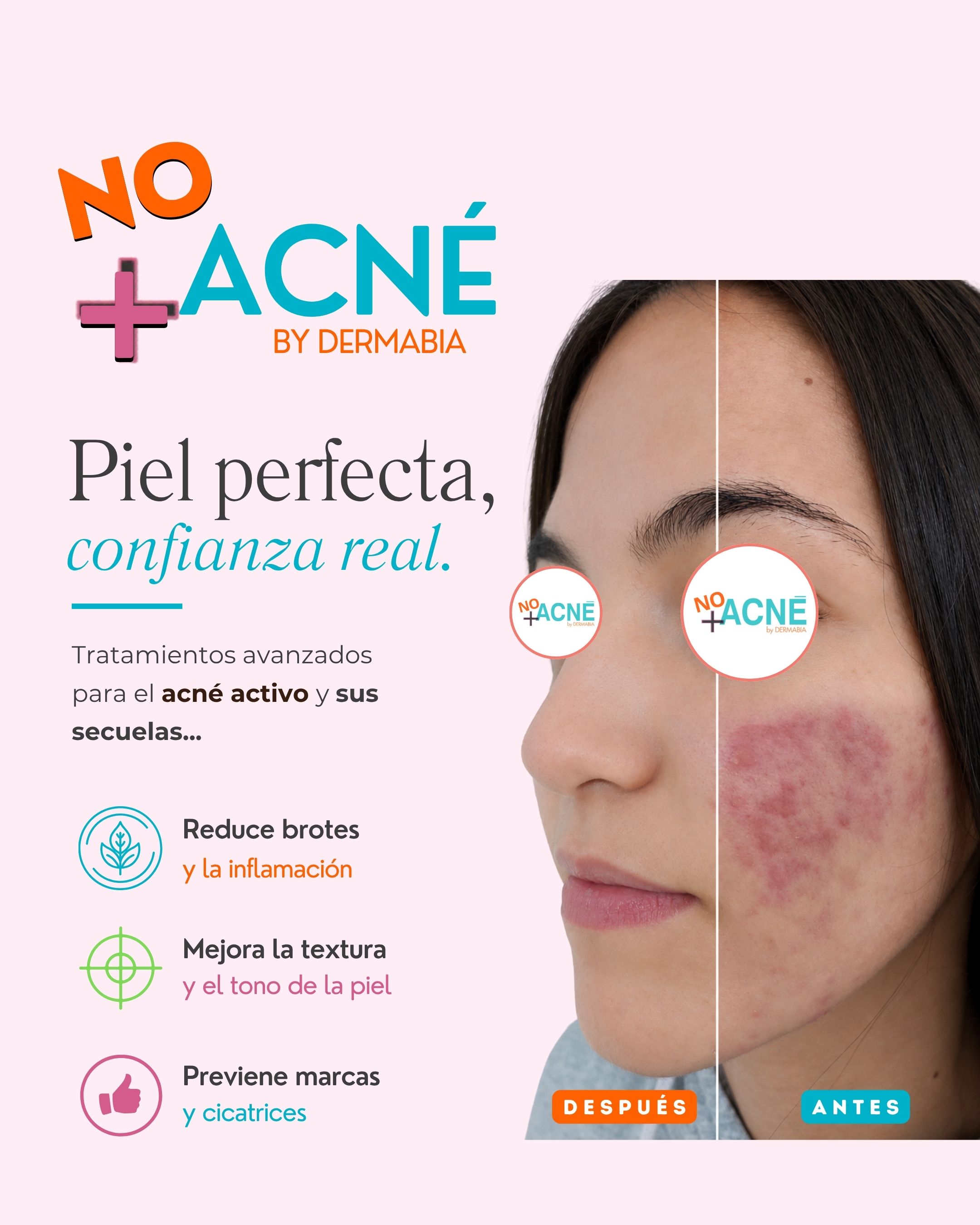 Antes y después del tratamiento de marcas de acné — resultado real 3